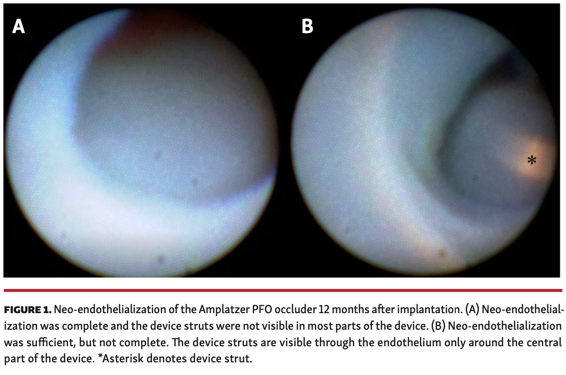 Tanabe PFO Occluder Figure 1