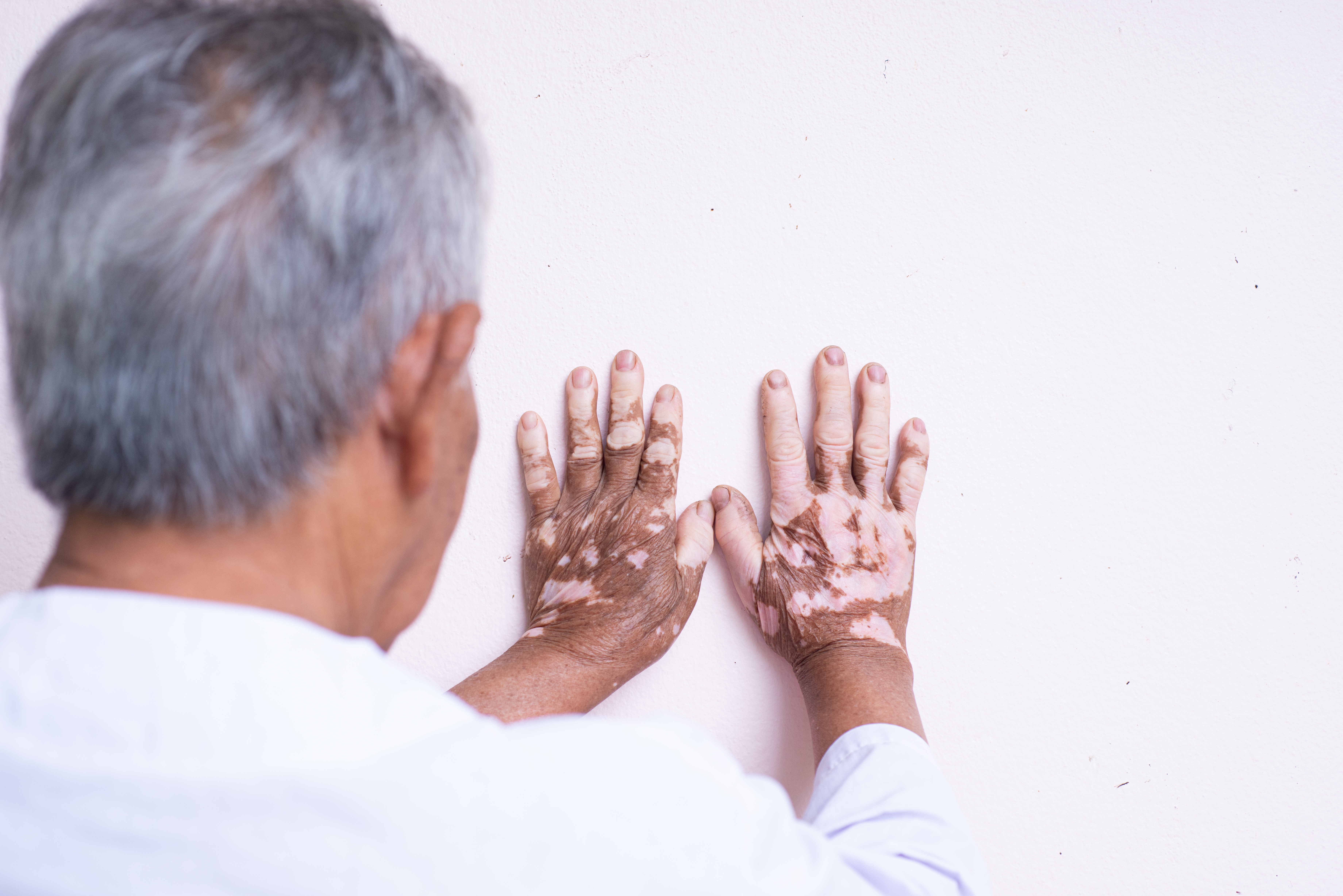 vitiligo