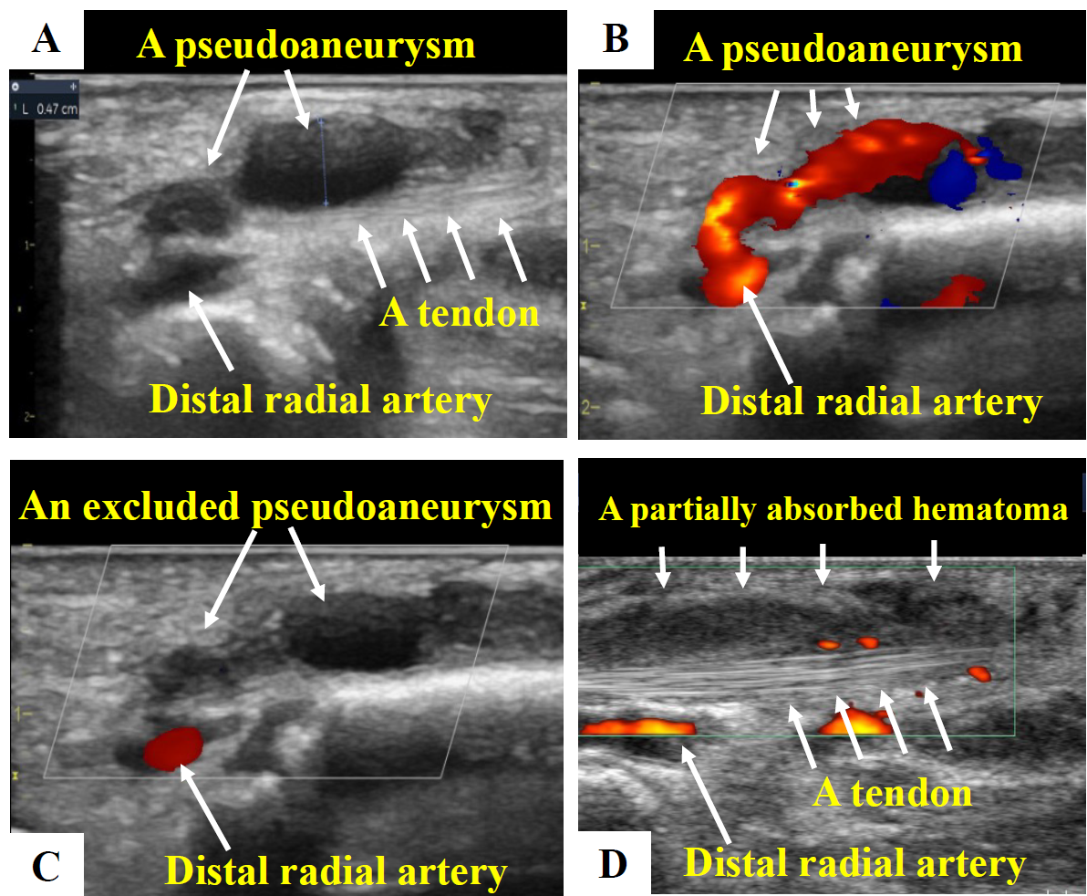 Tendinitis Induced by Distal Radial Artery Pseudoaneurysm Following a ...