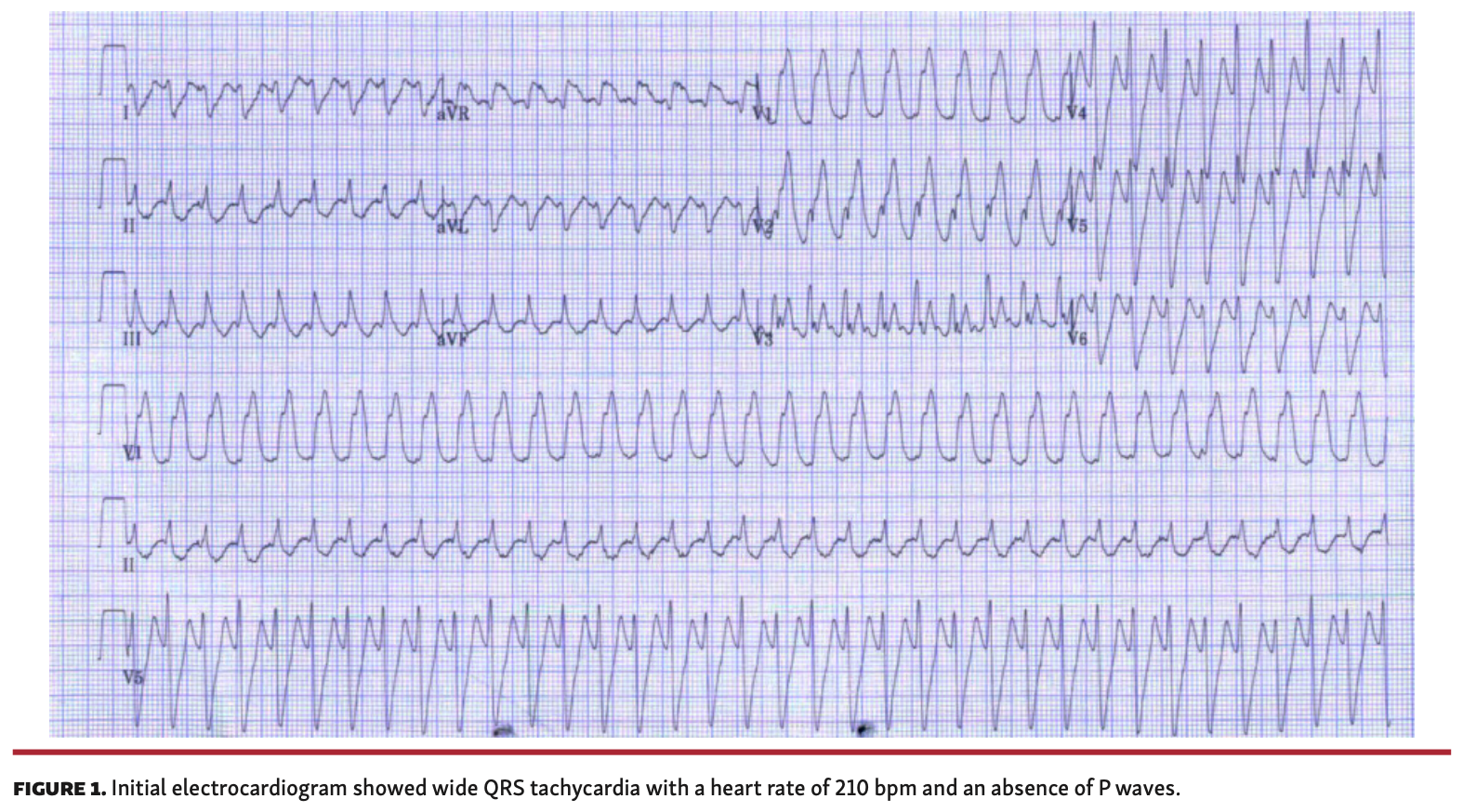 Yun Tachycardia Figure 1