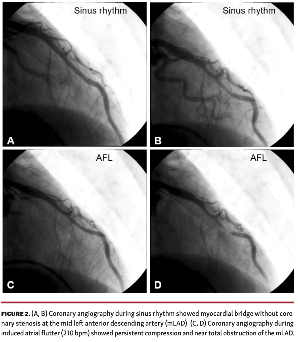 Yun Tachycardia Figure 2