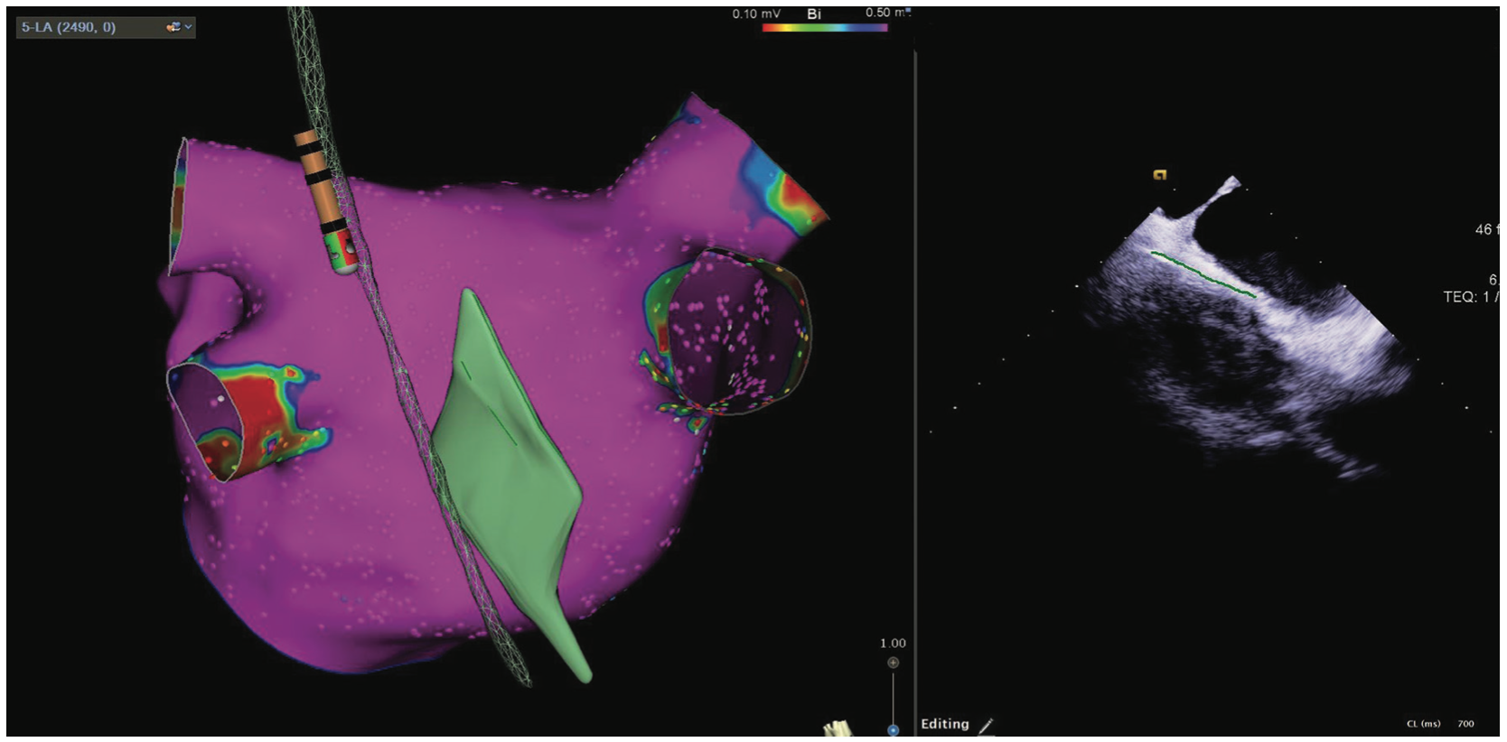 d'Avila Atrial Fibrillation Figure 2