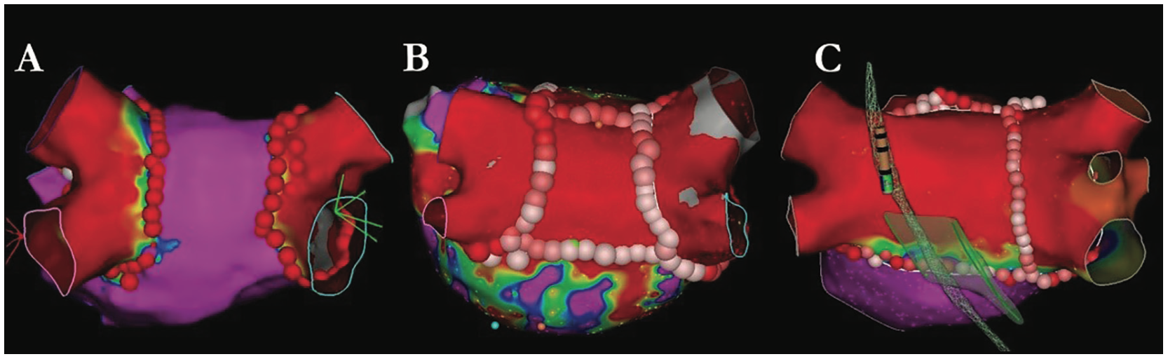 d'Avila Atrial Fibrillation Figure 3