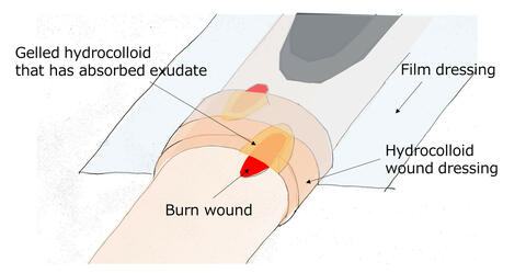 Hydrocolloid Wound Dressing for Sealing Periwound With Poor Normal