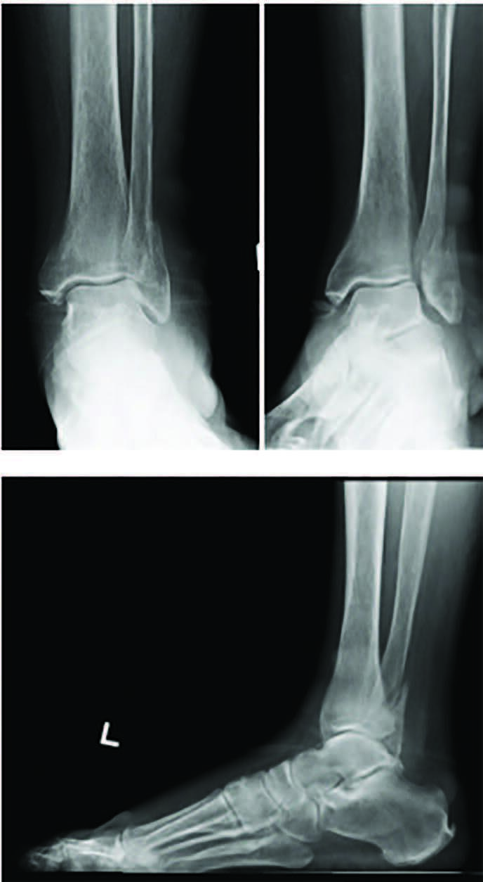Early WeightBearing Following Ankle Fracture ORIF