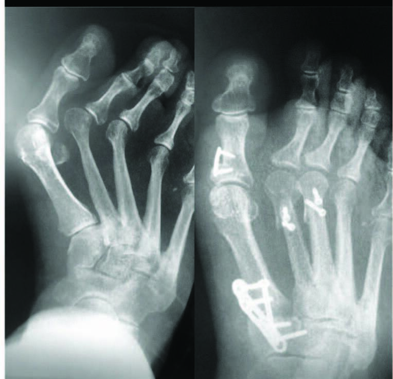 Metatarsus Adductus In The Adult Patient