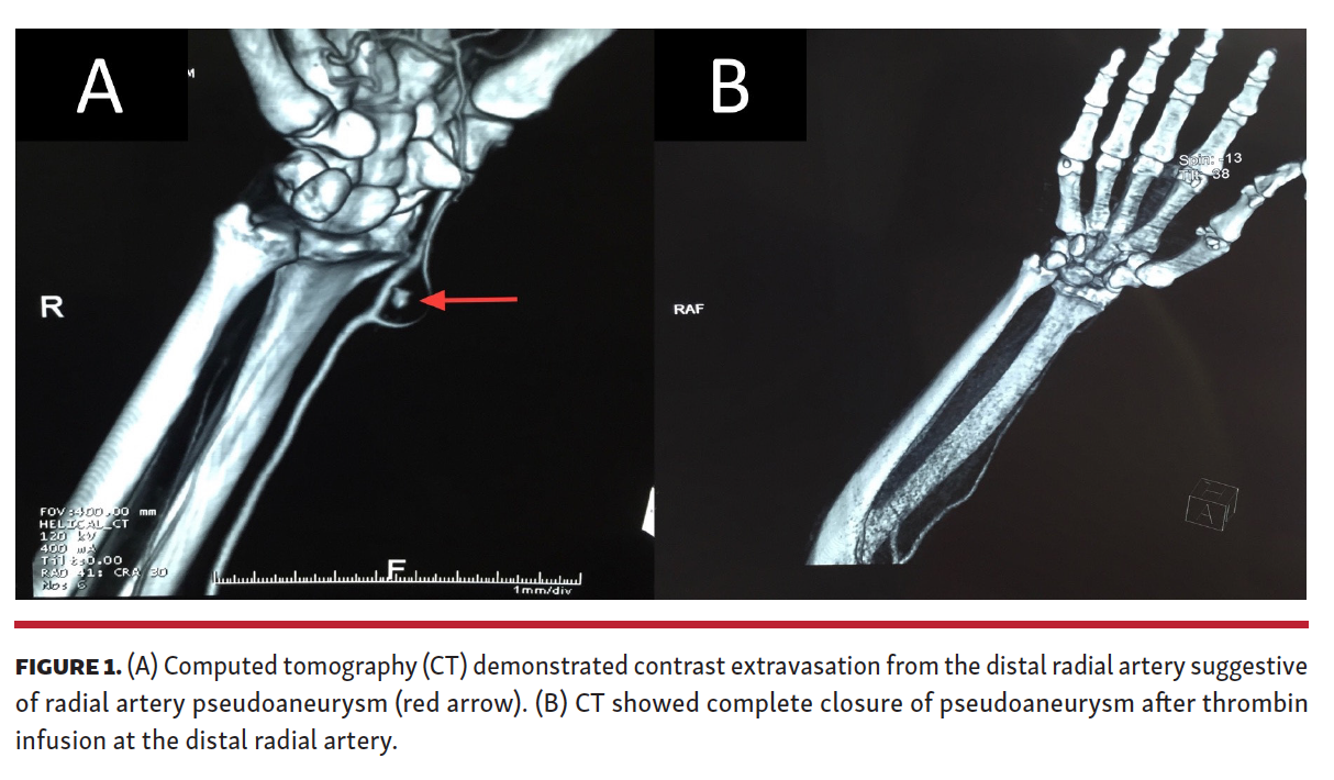 Radial Artery Pseudoaneurysm Following Percutaneous Coronary Intervention