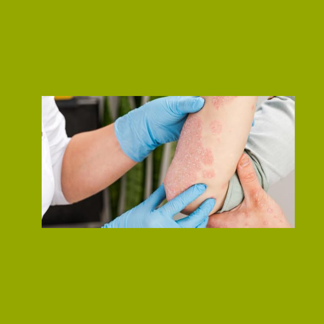 Atopic Dermatitis Women's Elbow