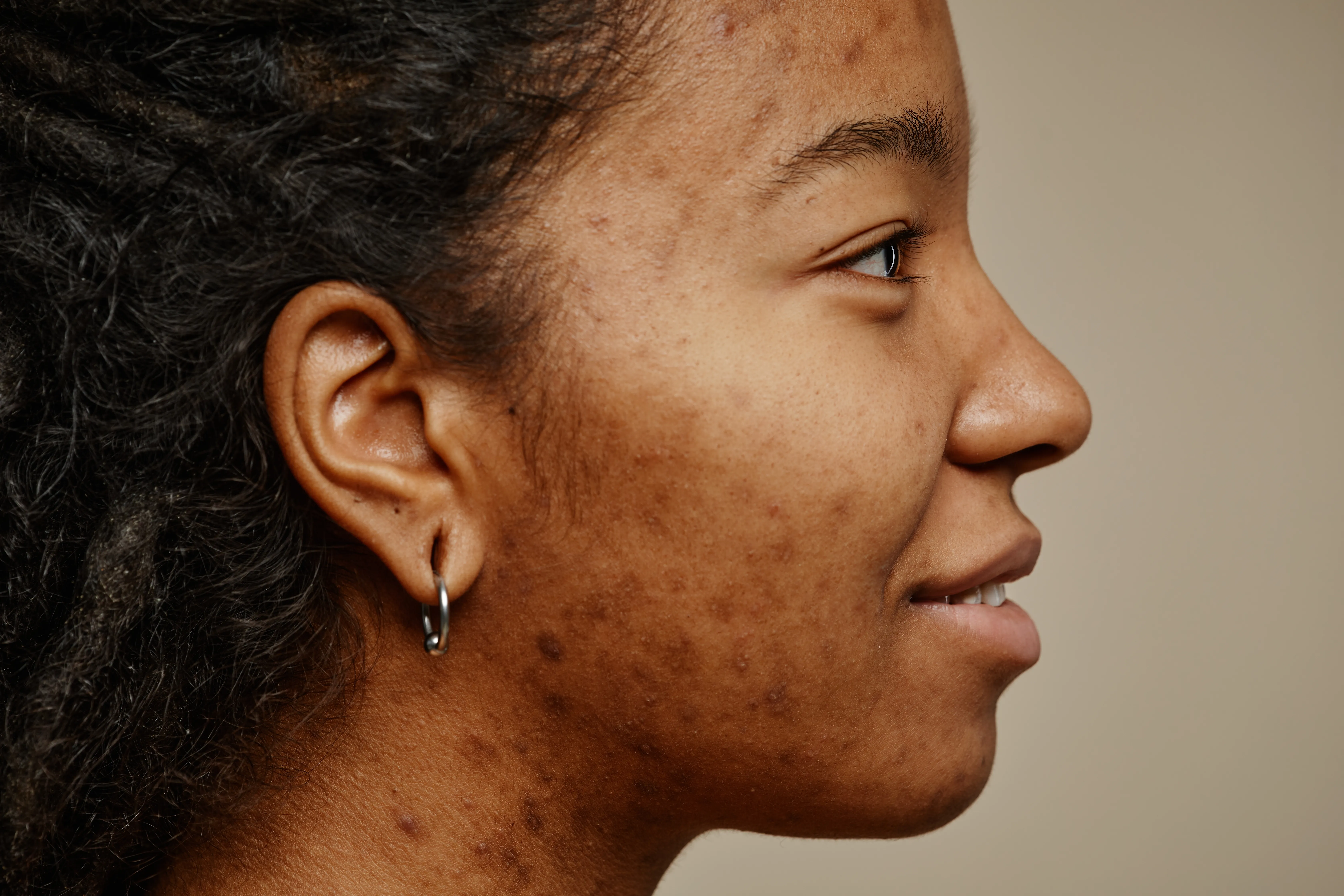 Skin Biostimulation for Scars and Stretch Marks