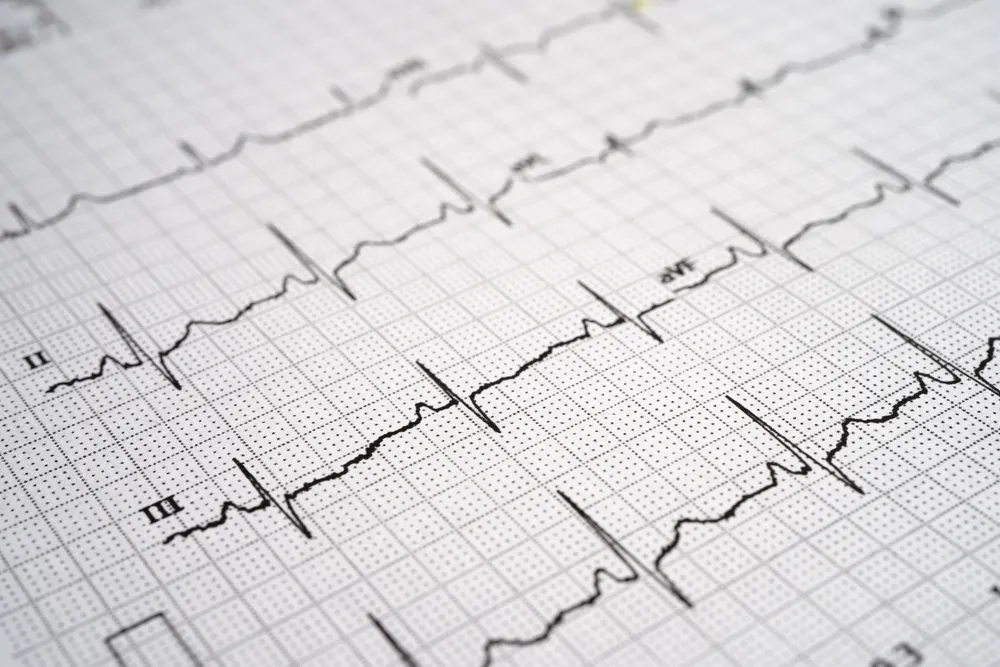 heart rhythm chart