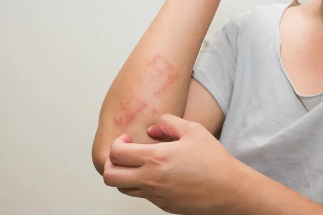 Meta-Analysis Links Atopic Dermatitis to Higher All-Cause and Cause-Specific Mortality