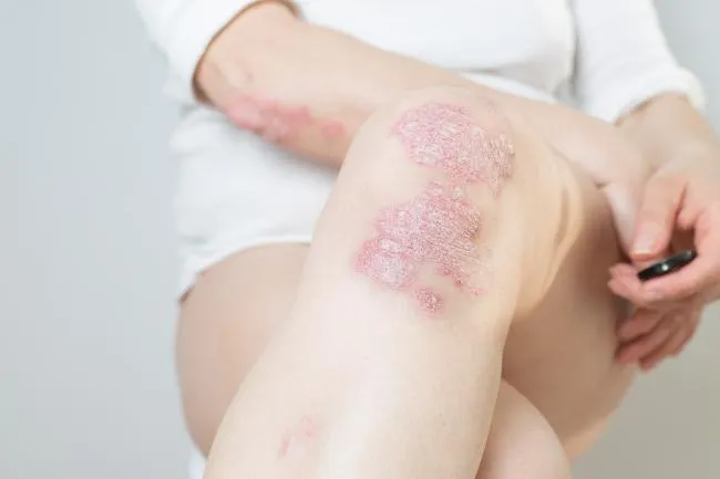 Real-World Registry Data Identify Predictors of Biologic Switching in Psoriasis Care