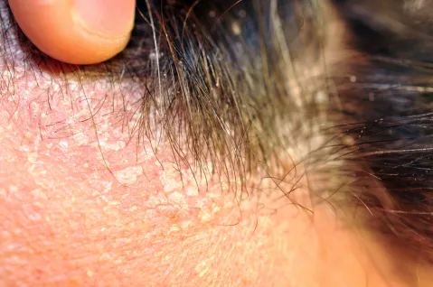 Seborrheic Dermatitis