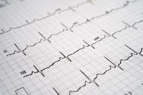 heart rhythm chart
