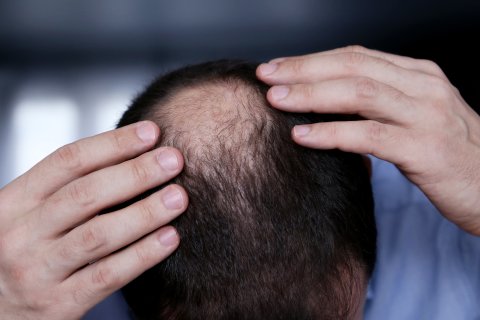 Hair Growth and Hair Loss