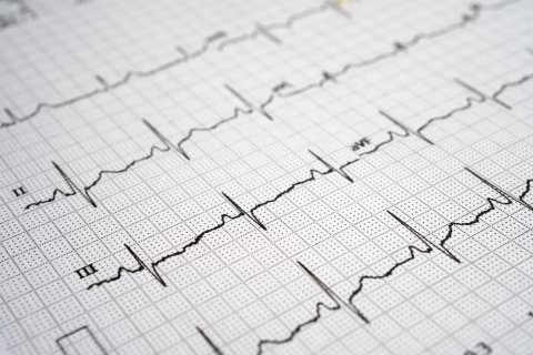 heart rhythm chart
