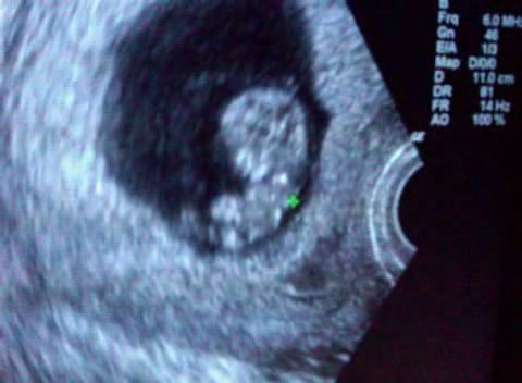 Ultrasound